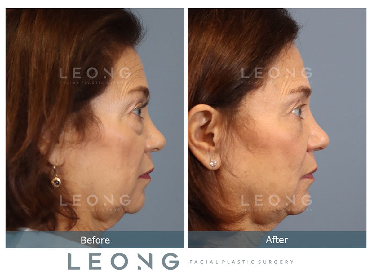 Blepharoplasty Before & After Gallery - Patient 770136 - Image 3