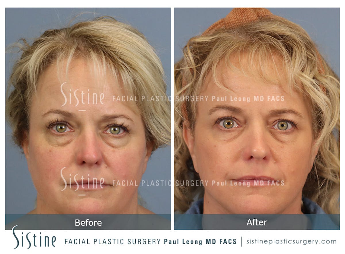 Blepharoplasty Before & After Gallery - Patient 277737 - Image 1