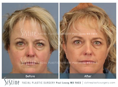 Blepharoplasty Before & After Gallery - Patient 277737 - Image 1