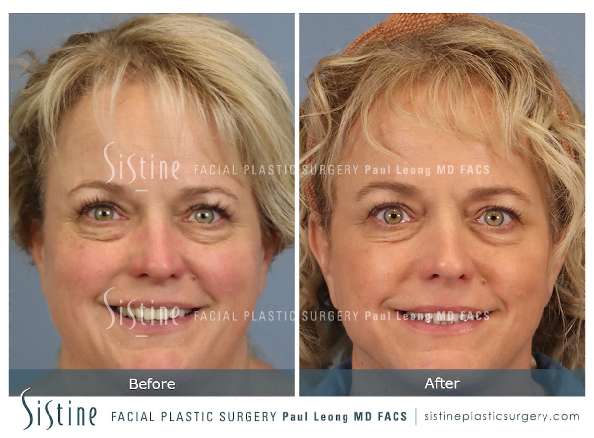 Blepharoplasty Before & After Gallery - Patient 277737 - Image 2