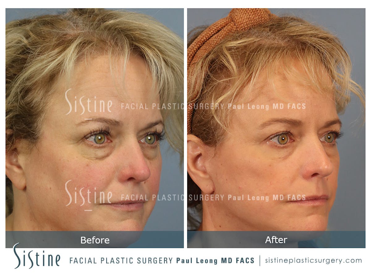 Blepharoplasty Before & After Gallery - Patient 277737 - Image 3