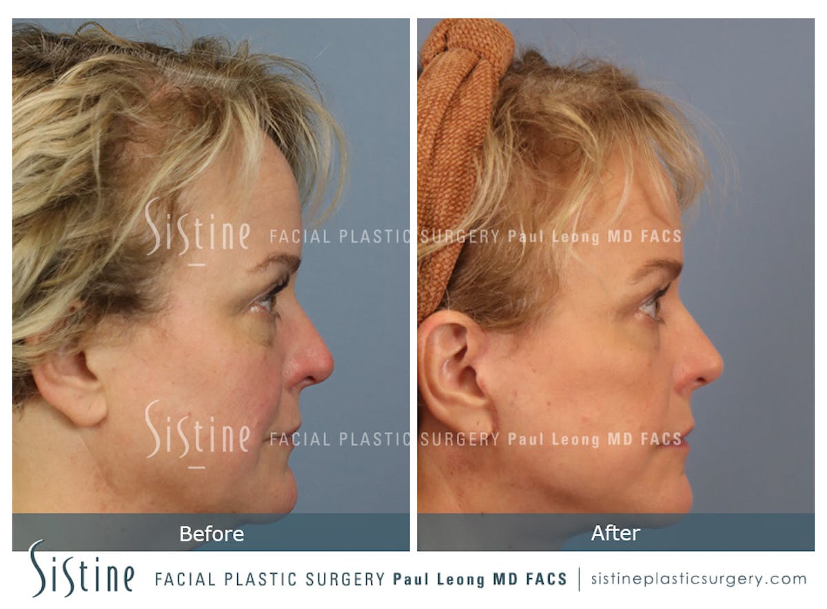 Blepharoplasty Before & After Gallery - Patient 277737 - Image 4