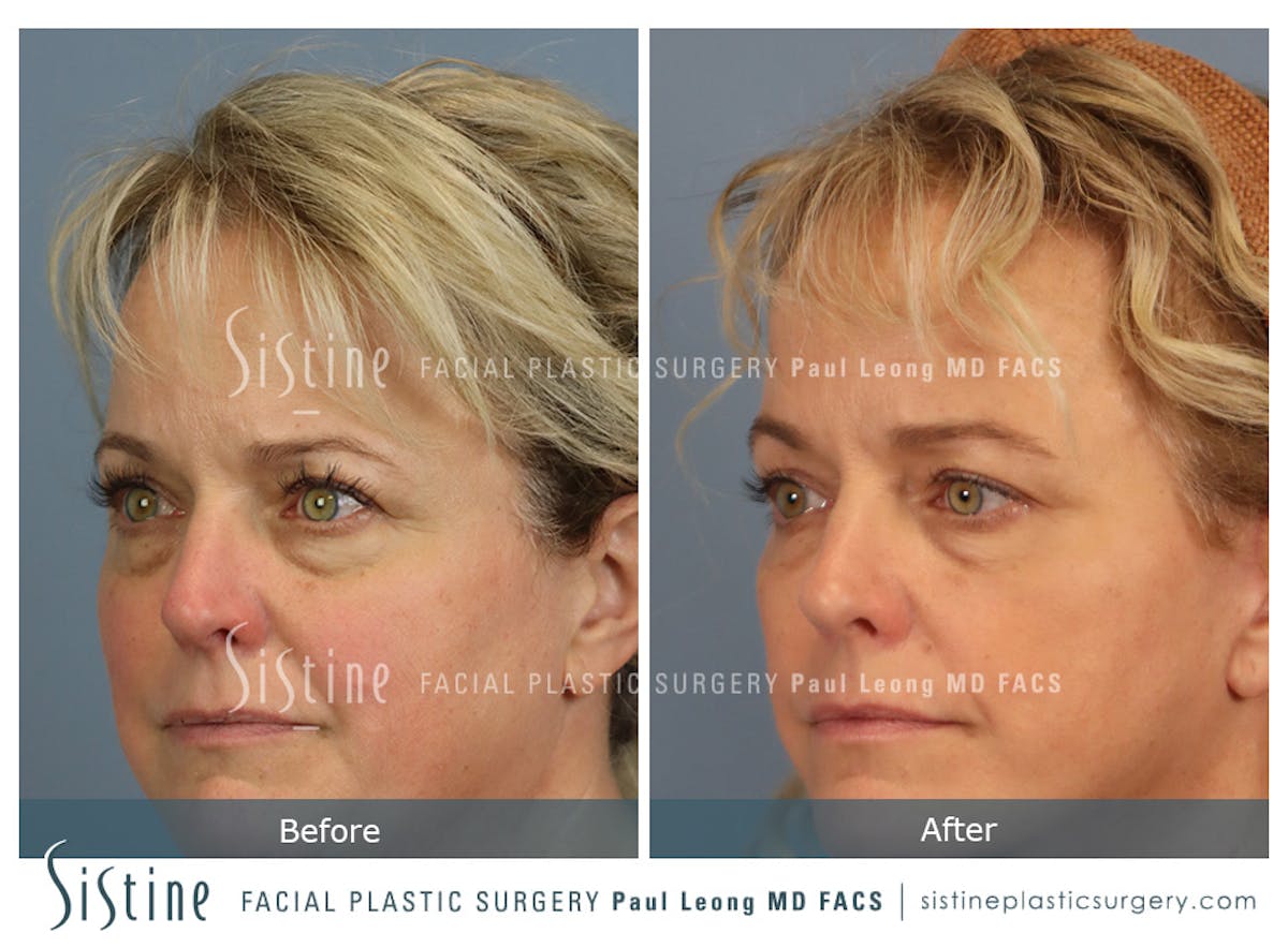 Blepharoplasty Before & After Gallery - Patient 277737 - Image 5