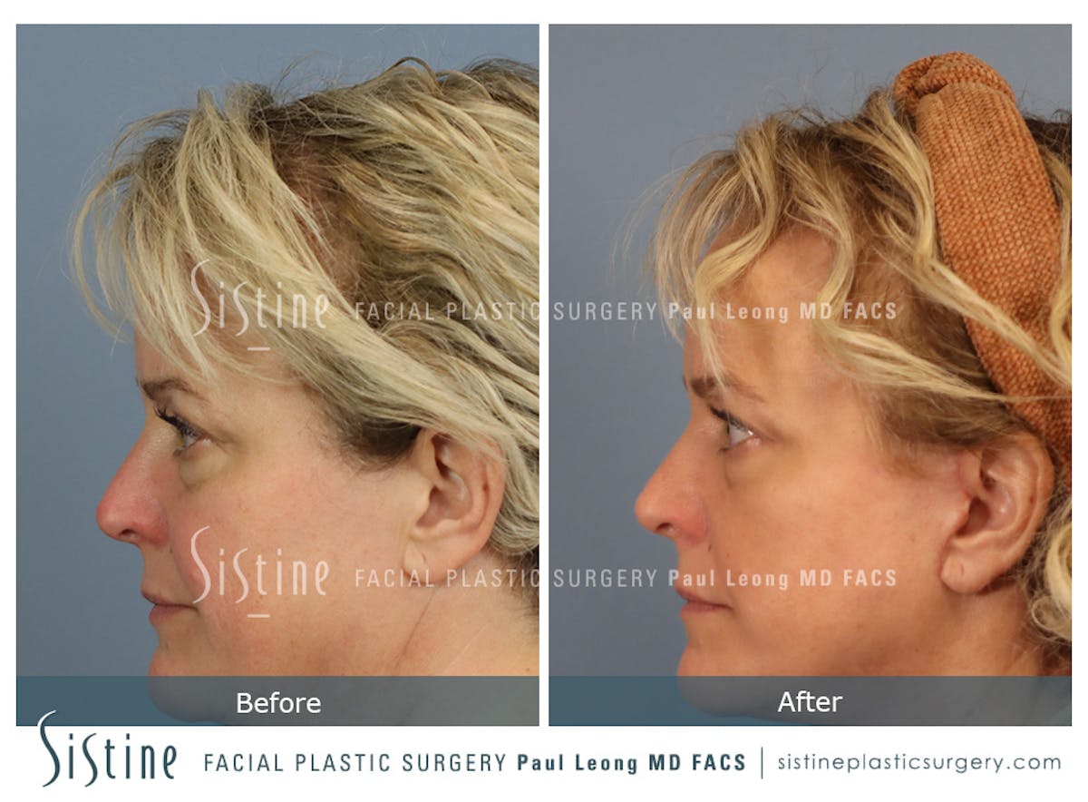 Blepharoplasty Before & After Gallery - Patient 277737 - Image 6