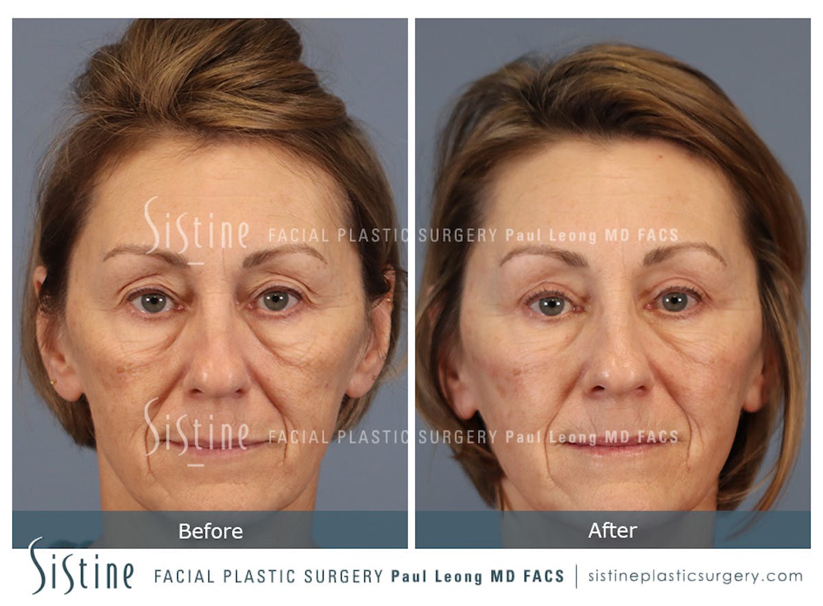 Blepharoplasty Before & After Gallery - Patient 147292 - Image 1