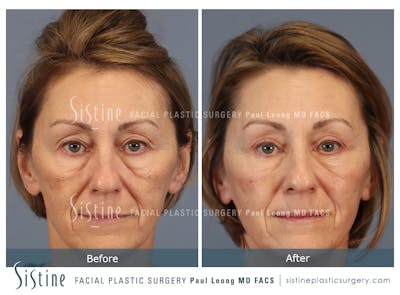 Blepharoplasty Before & After Gallery - Patient 147292 - Image 1