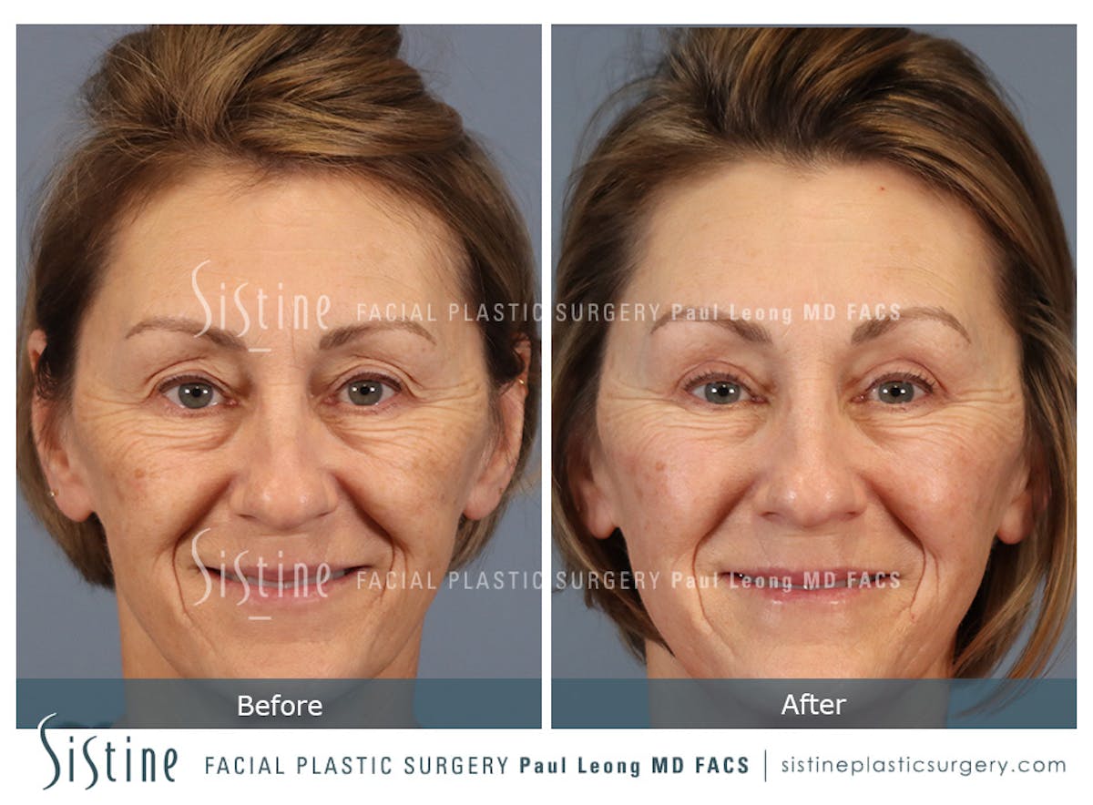 Blepharoplasty Before & After Gallery - Patient 147292 - Image 2