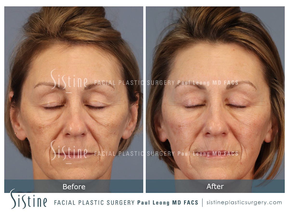Blepharoplasty Before & After Gallery - Patient 147292 - Image 3