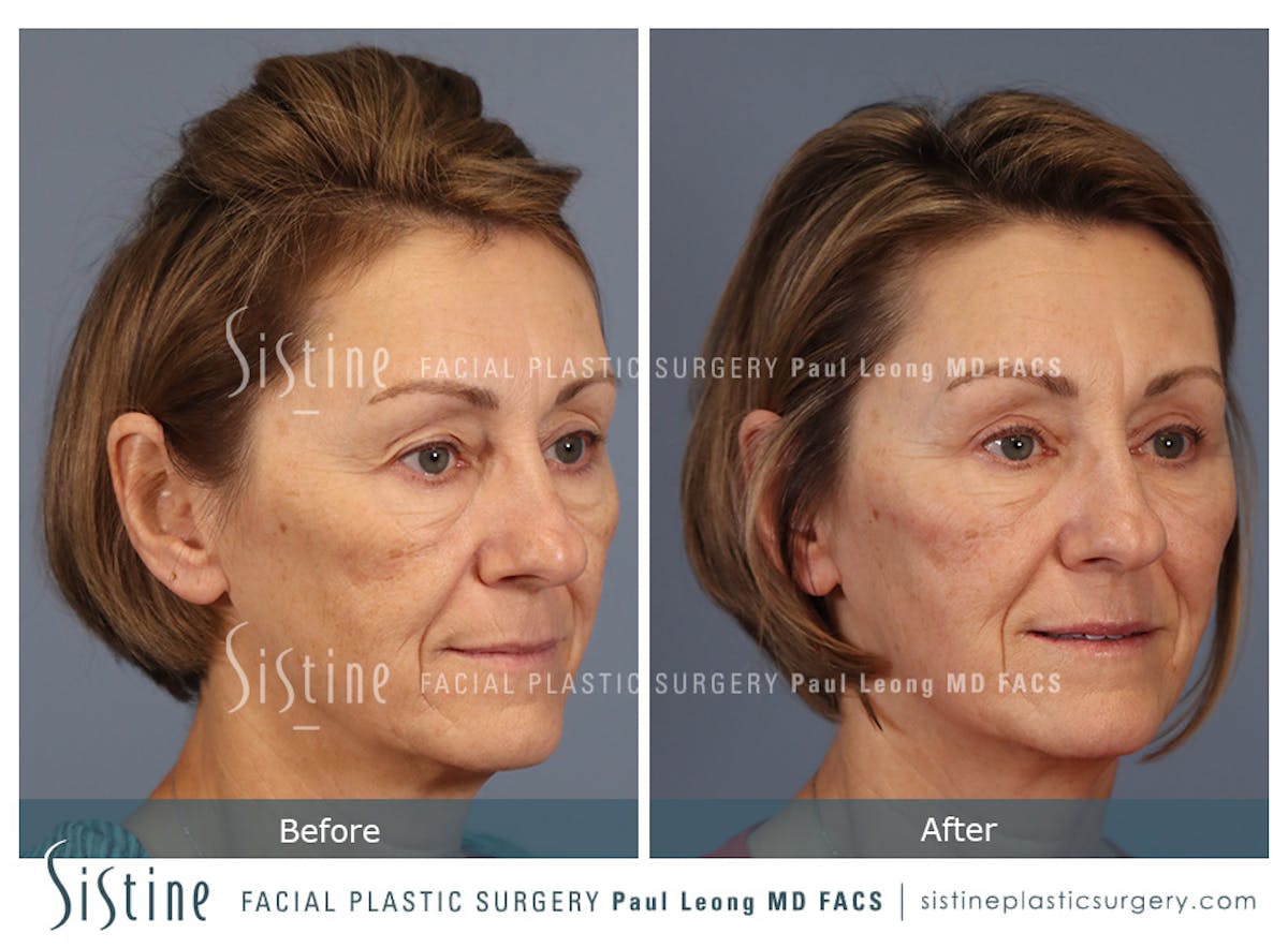 Blepharoplasty Before & After Gallery - Patient 147292 - Image 4