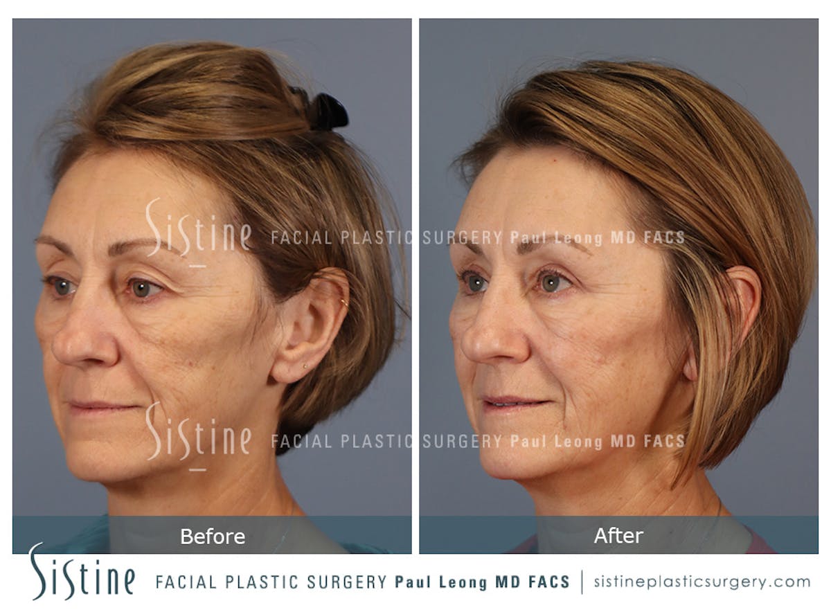 Blepharoplasty Before & After Gallery - Patient 147292 - Image 5