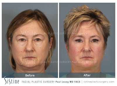 Blepharoplasty Before & After Gallery - Patient 382159 - Image 1