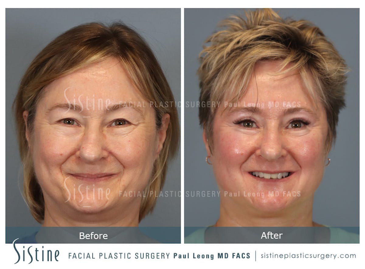 Blepharoplasty Before & After Gallery - Patient 382159 - Image 2
