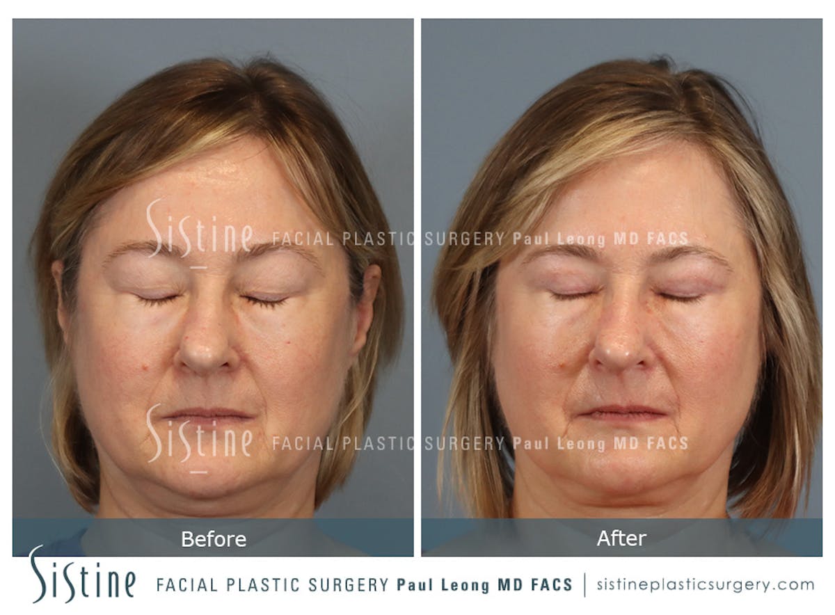 Blepharoplasty Before & After Gallery - Patient 382159 - Image 3