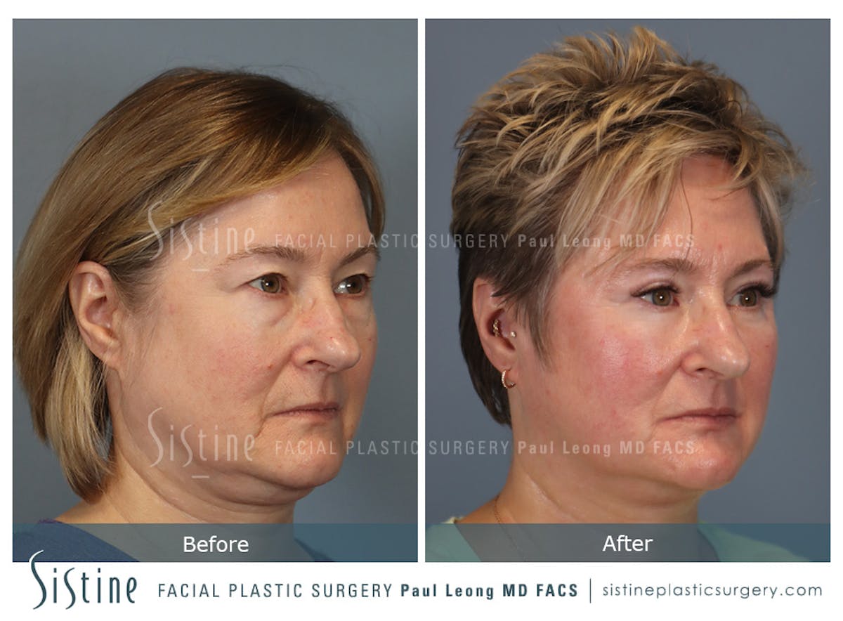 Blepharoplasty Before & After Gallery - Patient 382159 - Image 4