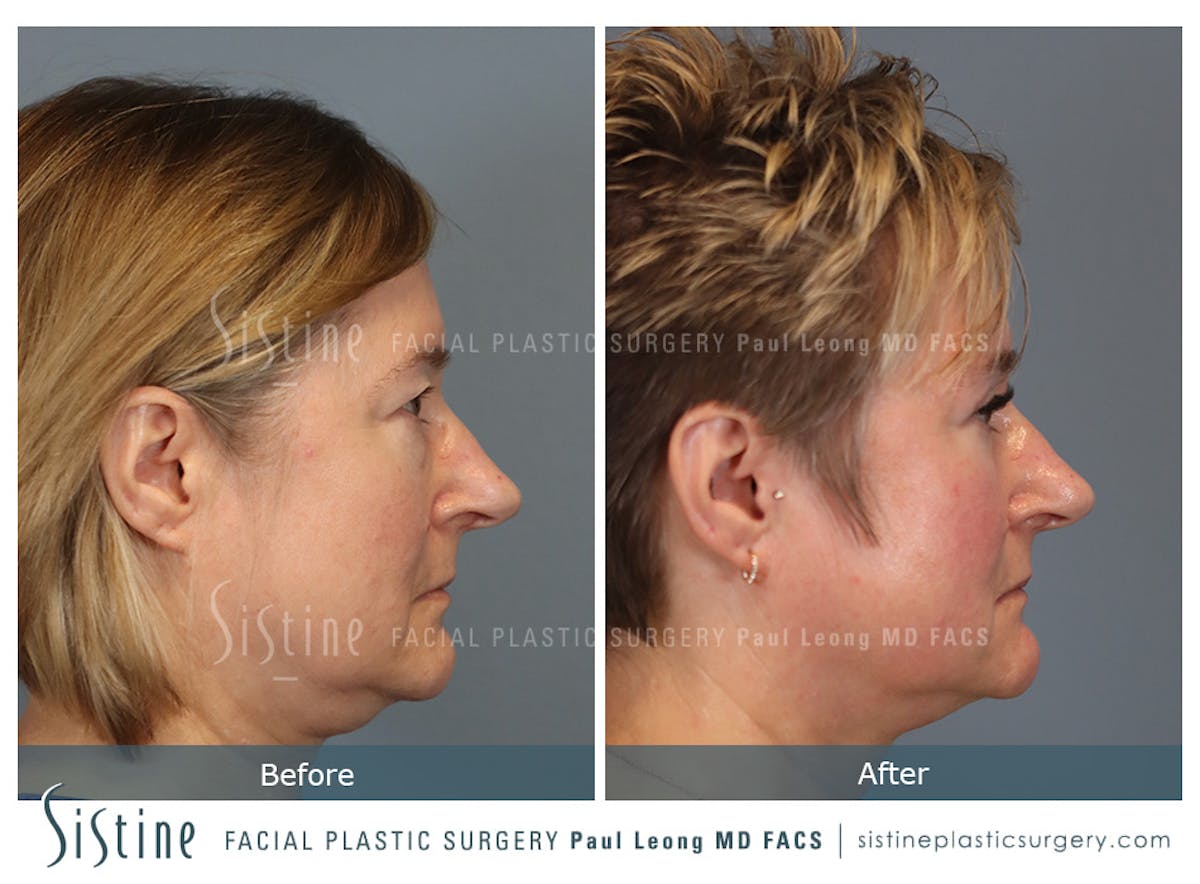 Blepharoplasty Before & After Gallery - Patient 382159 - Image 5