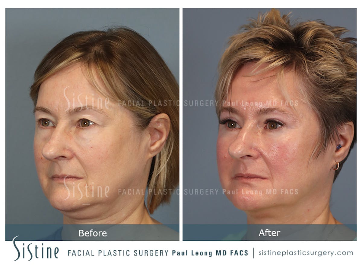 Blepharoplasty Before & After Gallery - Patient 382159 - Image 6