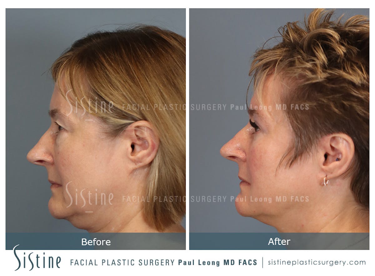 Blepharoplasty Before & After Gallery - Patient 382159 - Image 7