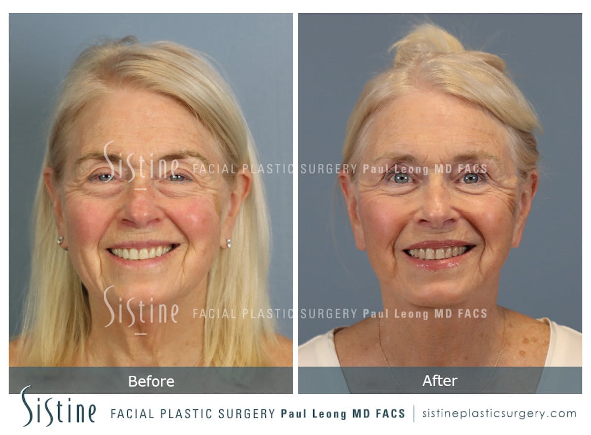 Deep Neck Lift Before & After Gallery - Patient 619684 - Image 1
