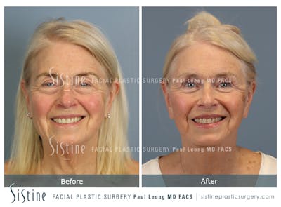 Blepharoplasty Before & After Gallery - Patient 378722 - Image 1