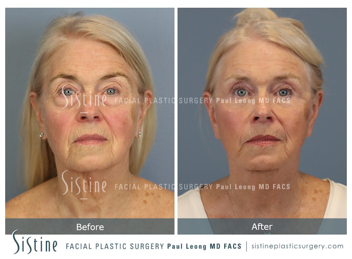 Deep Neck Lift Before & After Gallery - Patient 619684 - Image 2