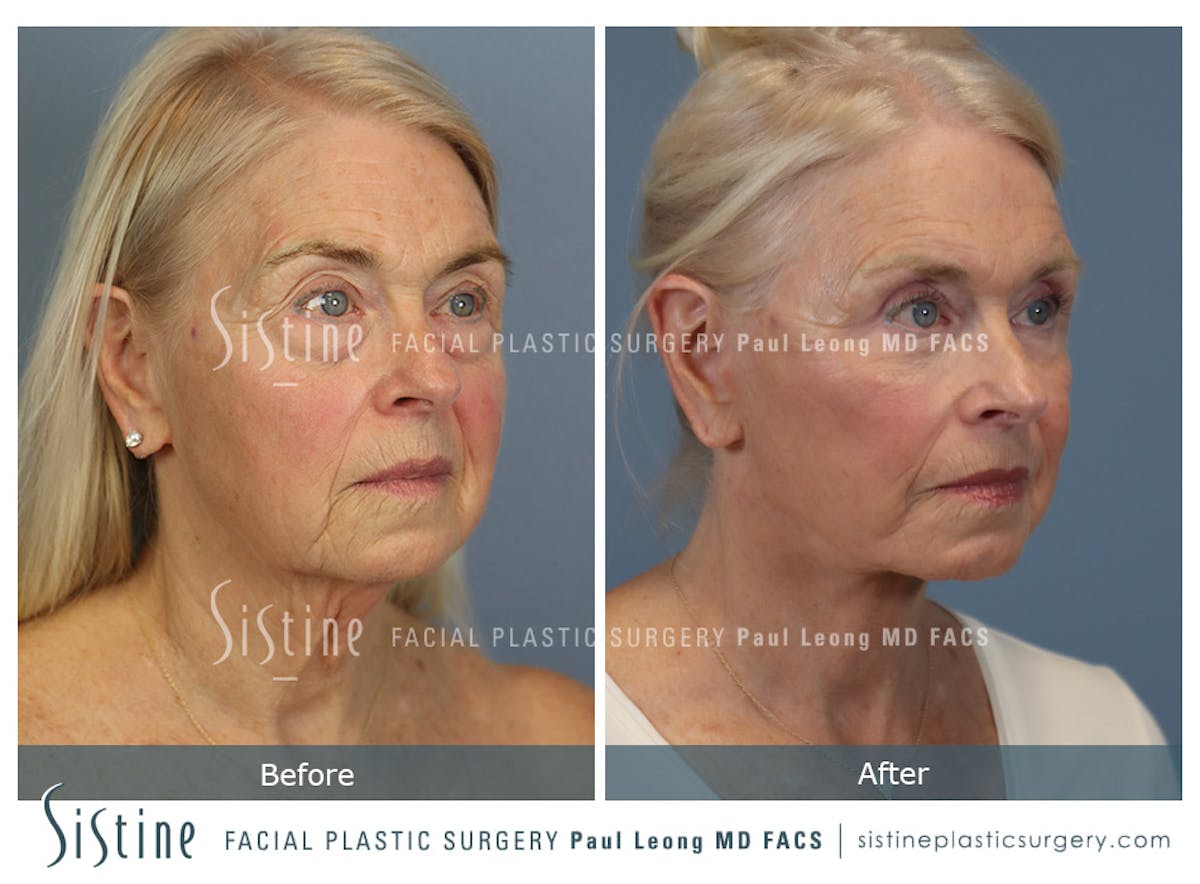 Deep Neck Lift Before & After Gallery - Patient 619684 - Image 3