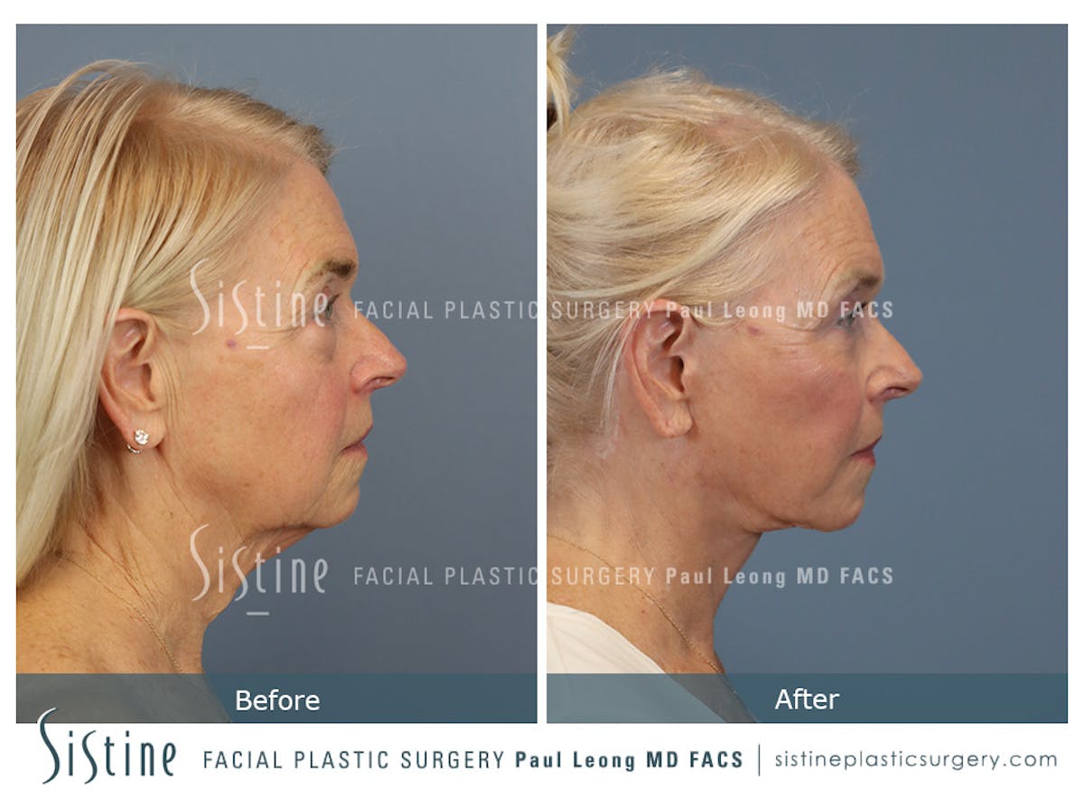 Deep Neck Lift Before & After Gallery - Patient 619684 - Image 4