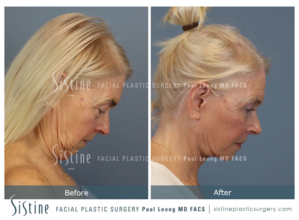 Deep Neck Lift Before & After Gallery - Patient 619684 - Image 5
