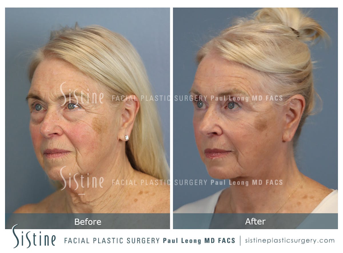 Deep Neck Lift Before & After Gallery - Patient 619684 - Image 6