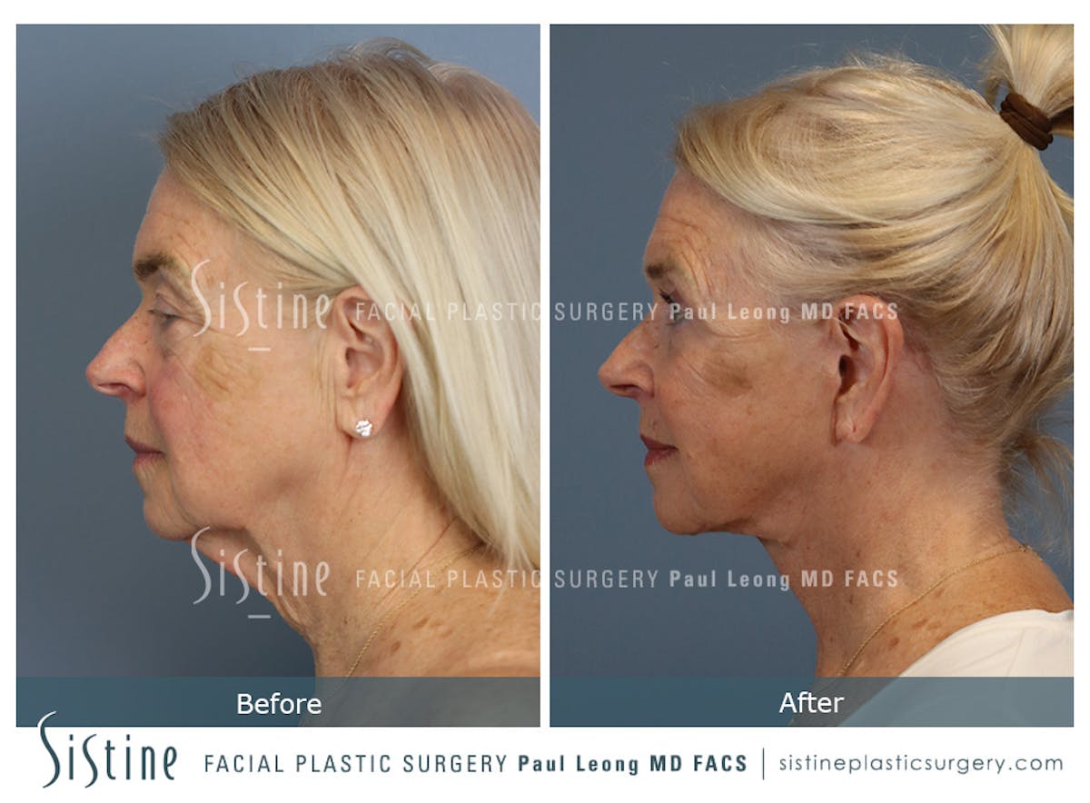 Deep Neck Lift Before & After Gallery - Patient 619684 - Image 7