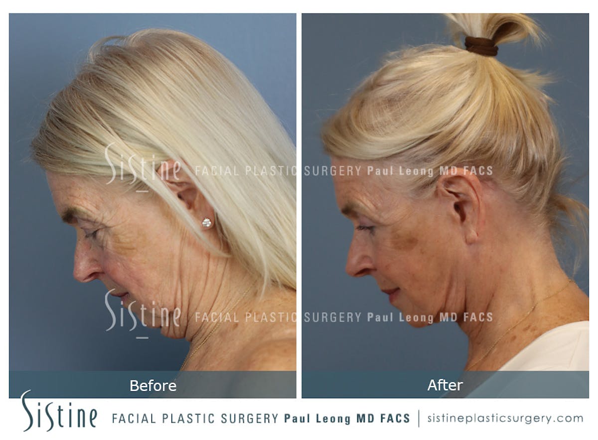 Deep Neck Lift Before & After Gallery - Patient 619684 - Image 8