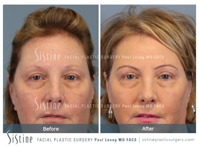 Blepharoplasty Before & After Gallery - Patient 264854 - Image 1