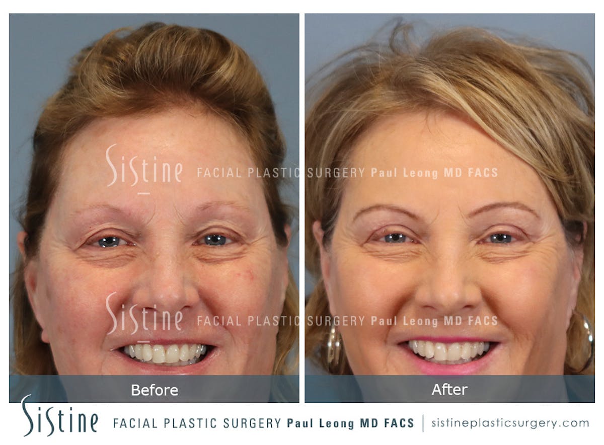 Blepharoplasty Before & After Gallery - Patient 264854 - Image 2