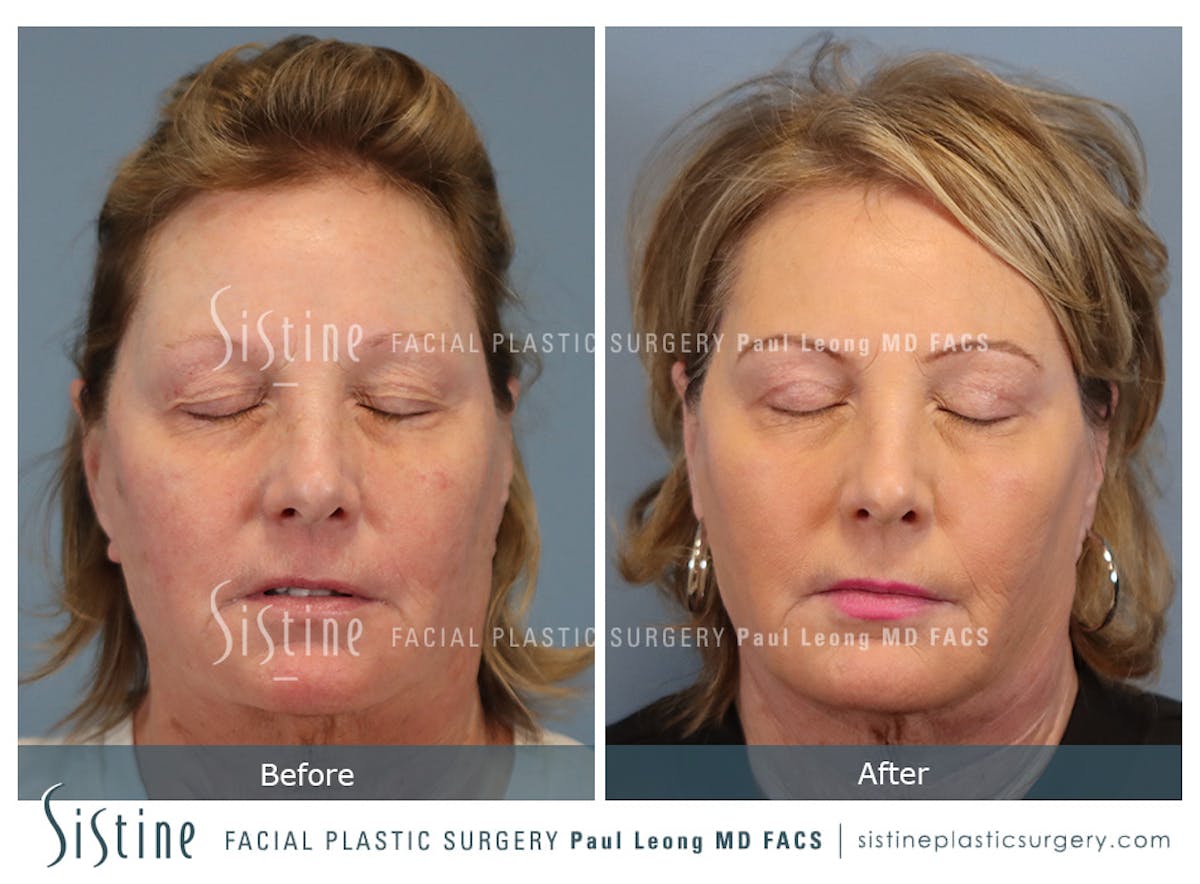 Blepharoplasty Before & After Gallery - Patient 264854 - Image 3