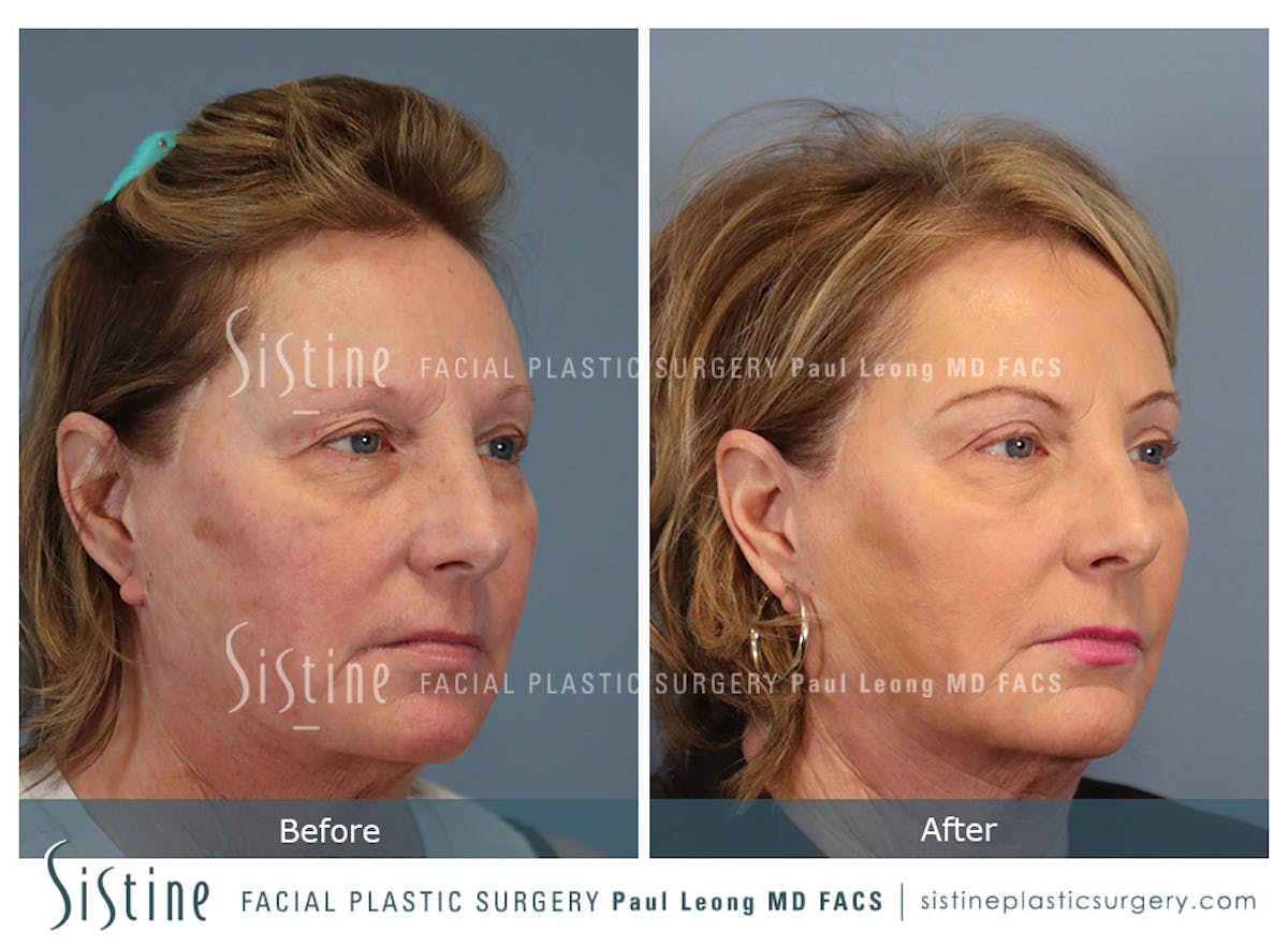 Blepharoplasty Before & After Gallery - Patient 264854 - Image 4