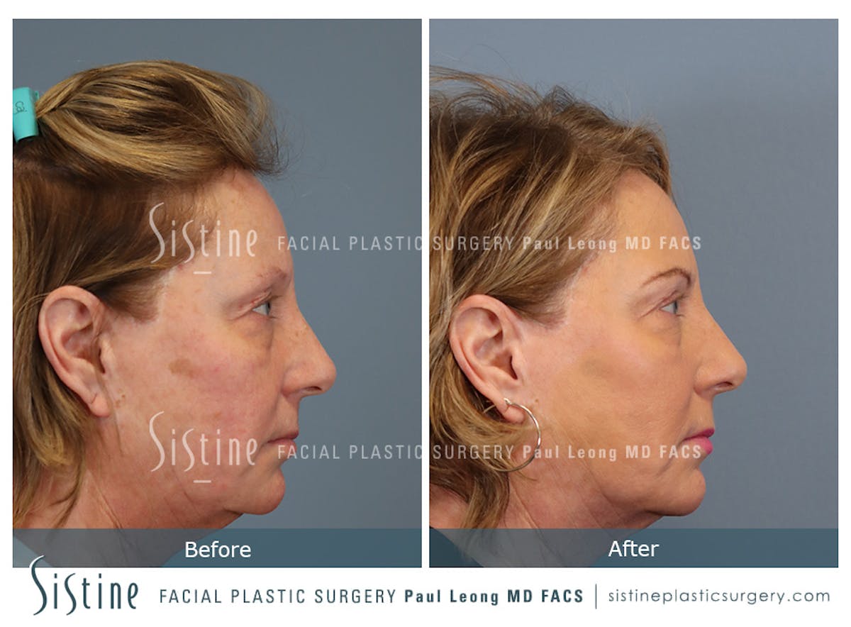 Blepharoplasty Before & After Gallery - Patient 264854 - Image 5