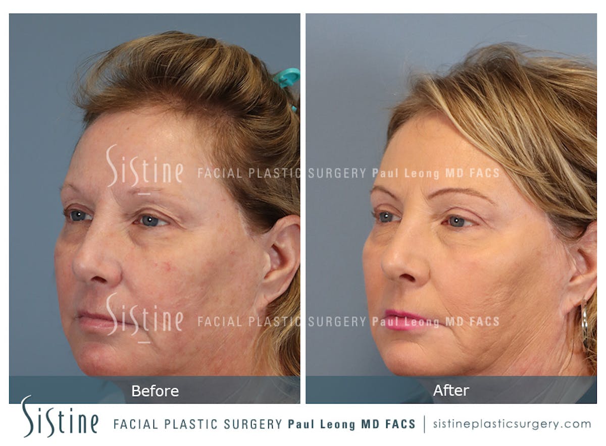Blepharoplasty Before & After Gallery - Patient 264854 - Image 6
