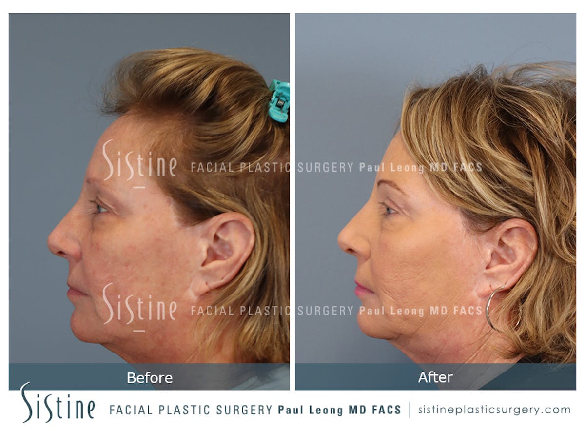 Blepharoplasty Before & After Gallery - Patient 264854 - Image 7