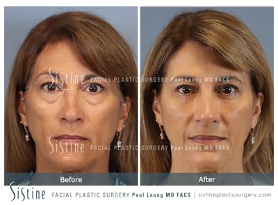 Blepharoplasty Before & After Gallery - Patient 365603 - Image 1