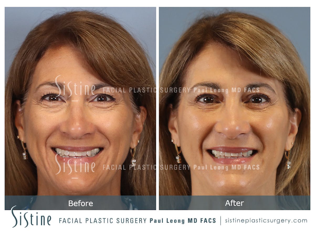 Blepharoplasty Before & After Gallery - Patient 365603 - Image 2