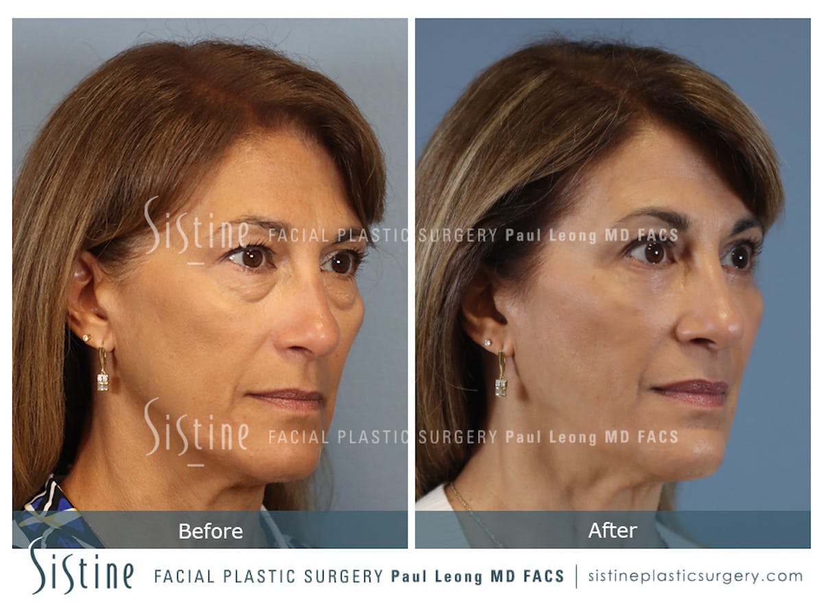 Blepharoplasty Before & After Gallery - Patient 365603 - Image 3
