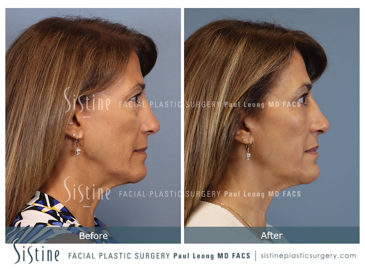 Blepharoplasty Before & After Gallery - Patient 365603 - Image 4