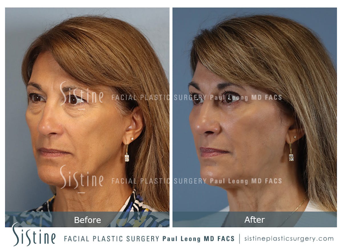 Blepharoplasty Before & After Gallery - Patient 365603 - Image 5