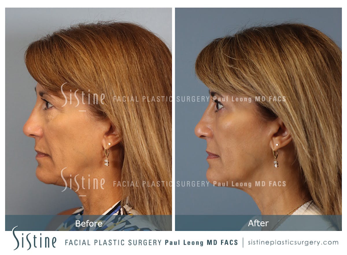 Blepharoplasty Before & After Gallery - Patient 365603 - Image 6