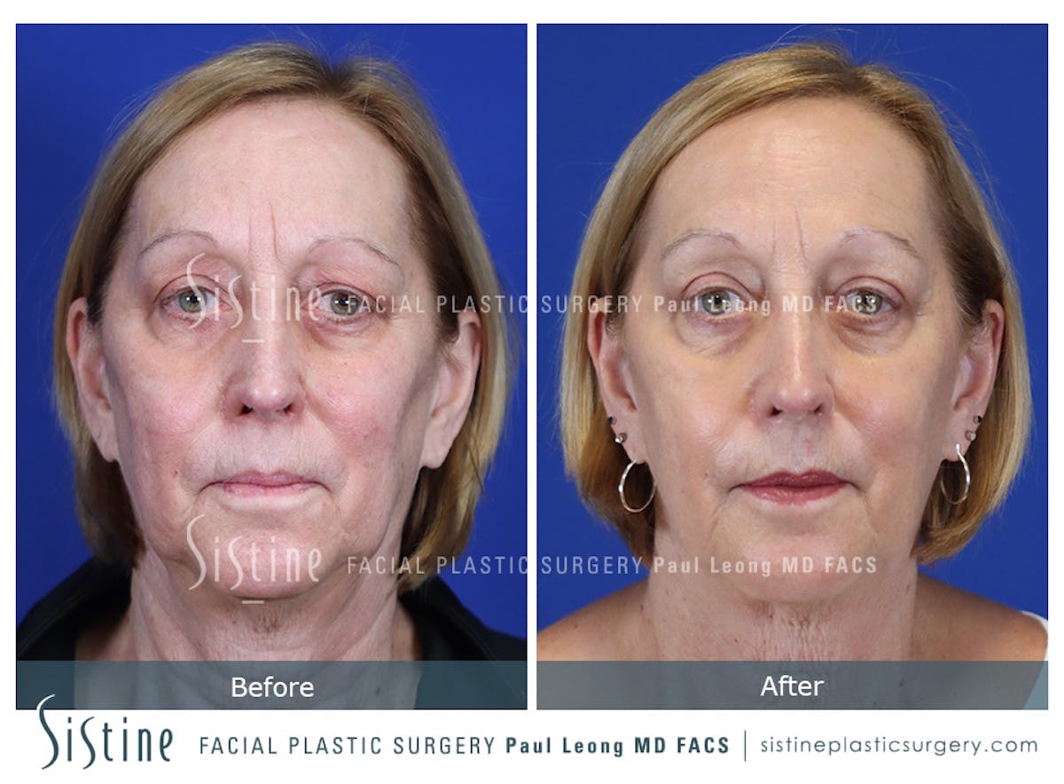 Blepharoplasty Before & After Gallery - Patient 225275 - Image 1