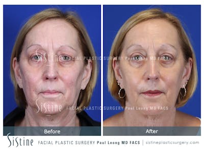 Blepharoplasty Before & After Gallery - Patient 225275 - Image 1
