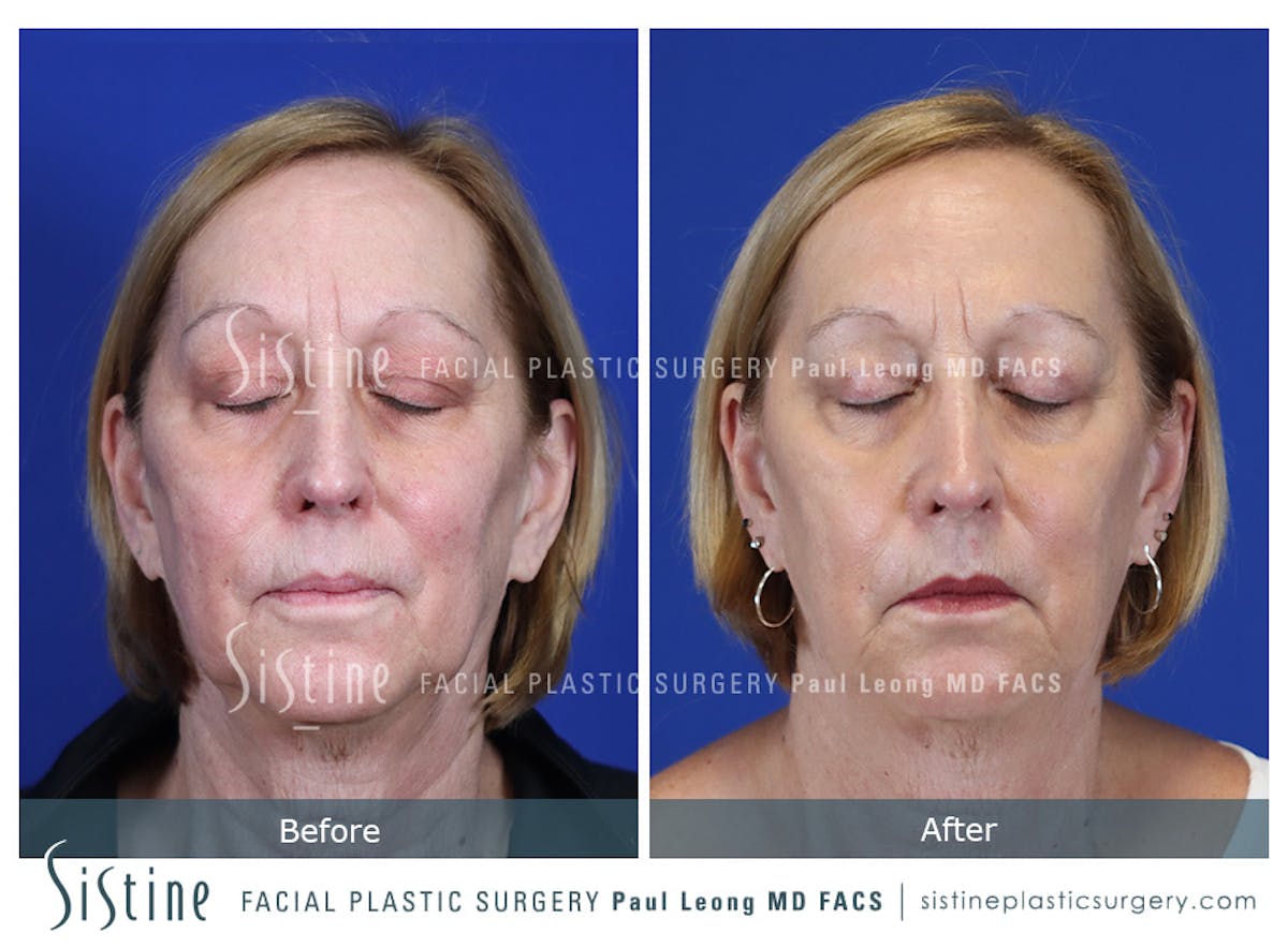 Blepharoplasty Before & After Gallery - Patient 225275 - Image 2