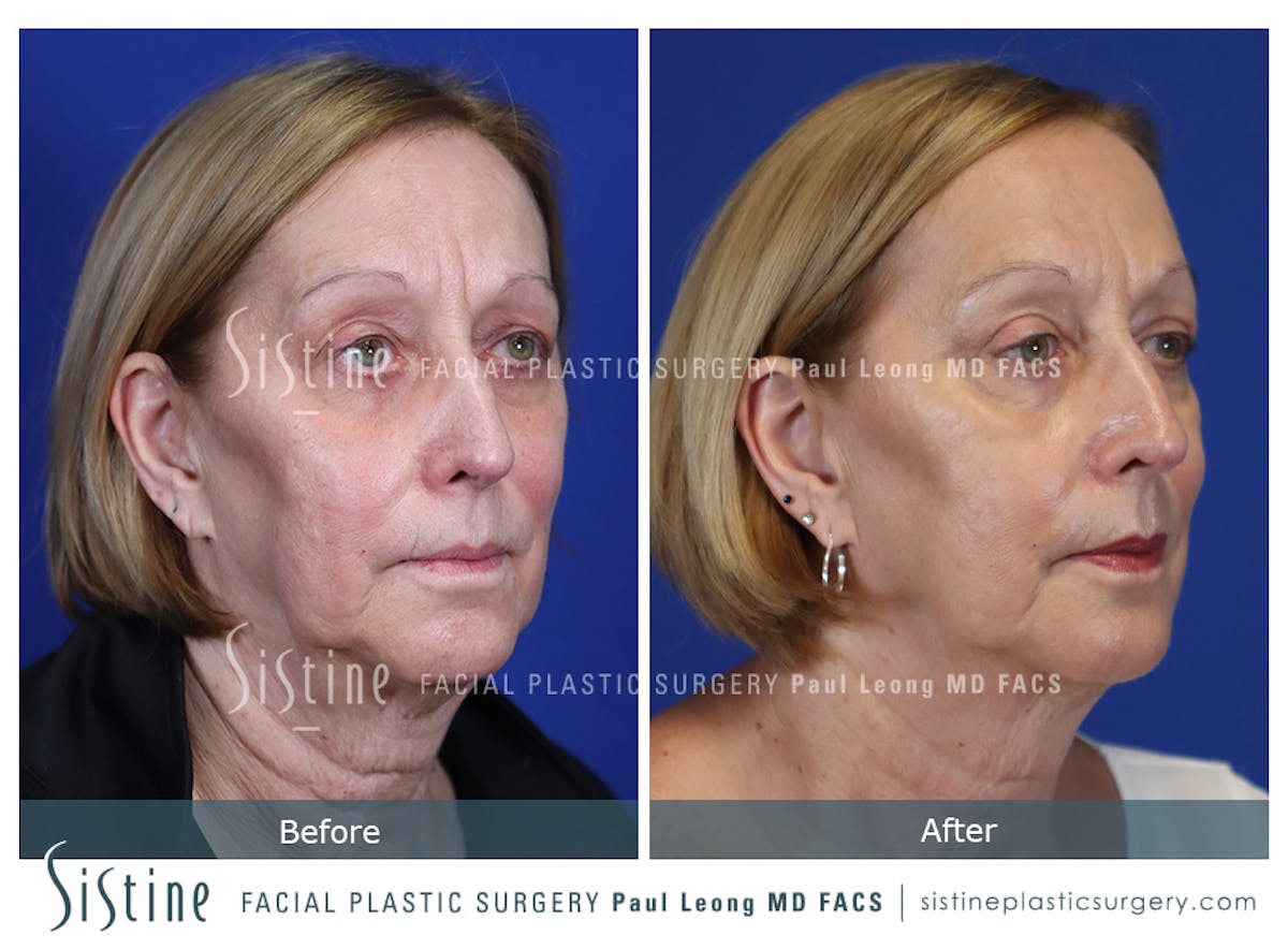 Blepharoplasty Before & After Gallery - Patient 225275 - Image 3