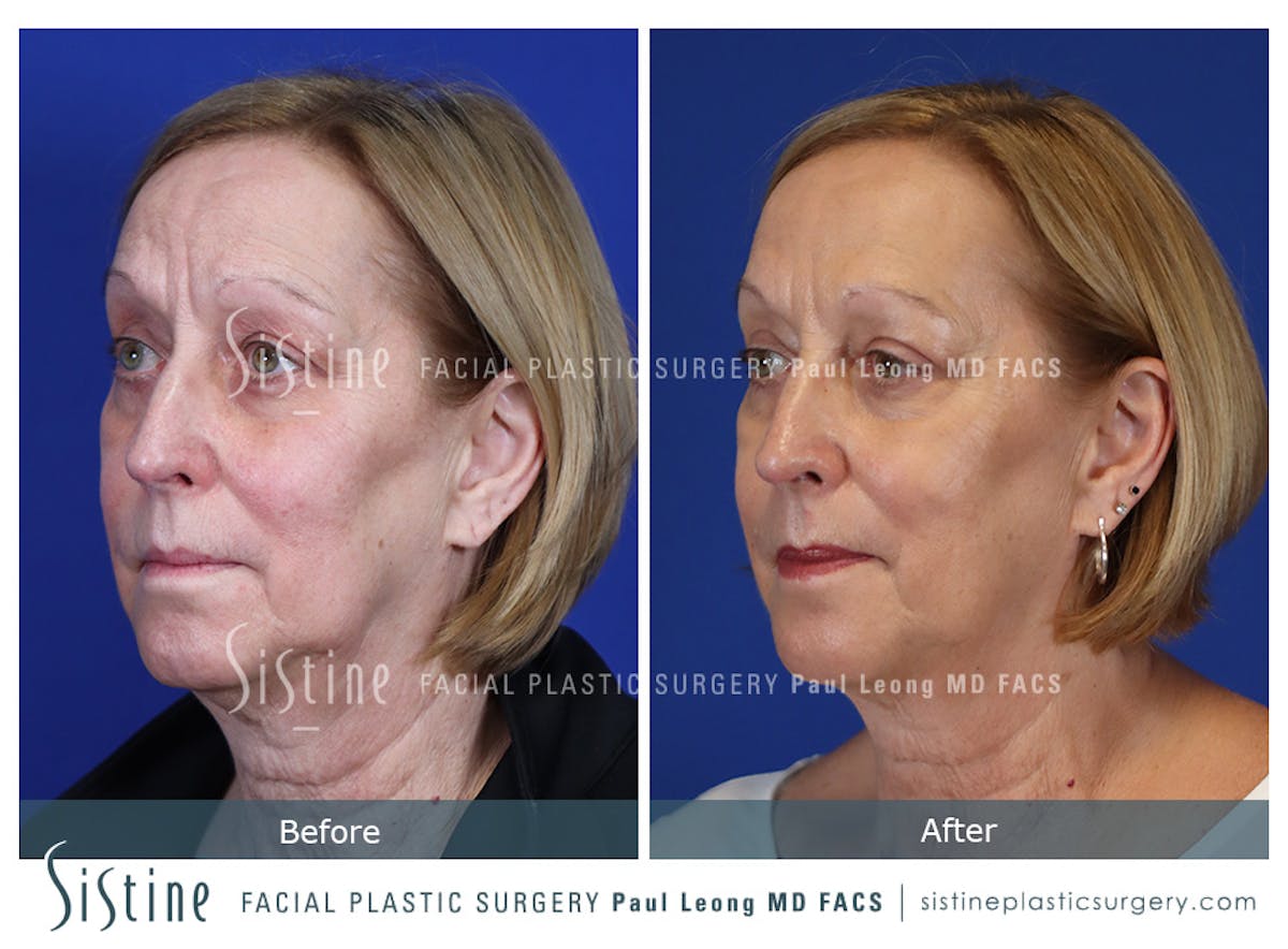 Blepharoplasty Before & After Gallery - Patient 225275 - Image 4
