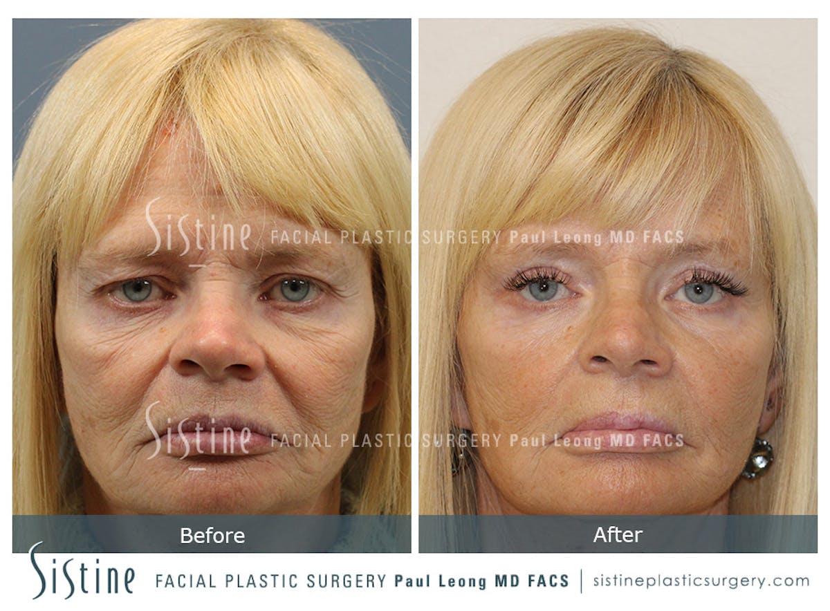 Blepharoplasty Before & After Gallery - Patient 340633 - Image 1