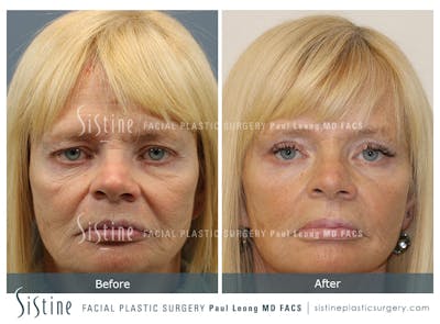 Blepharoplasty Before & After Gallery - Patient 340633 - Image 1